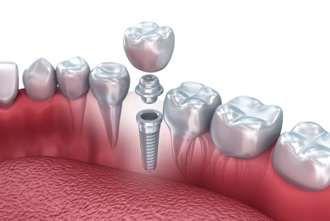 О Имплантации зубов
